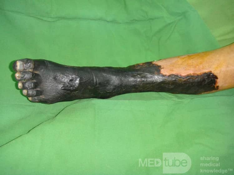 Cut off the leg The right time for amputation