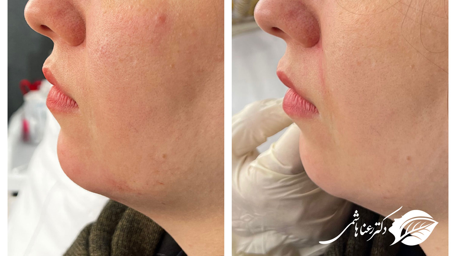 مراقبت های بعد از تزریق ژل چانه