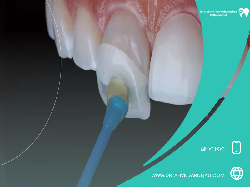 Getting to know the reasons for grinding teeth for laminate, the process and its advantages and disadvantages Dr. Zadrudarnjad