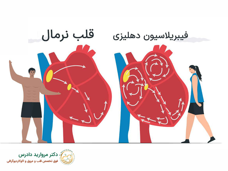 كل شيء عن الرجفان الأذيني (من التشخيص إلى السيطرة) - د. مارفاريد دادريس