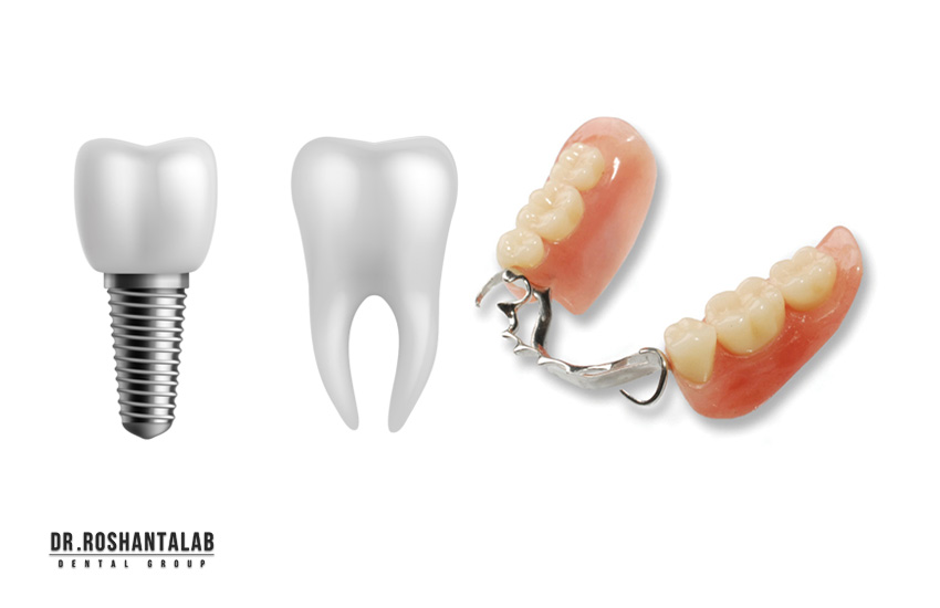 ایمپلنت دندان و مقایسه با پروتز مصنوعی و بریج: 5 تفاوت مهم