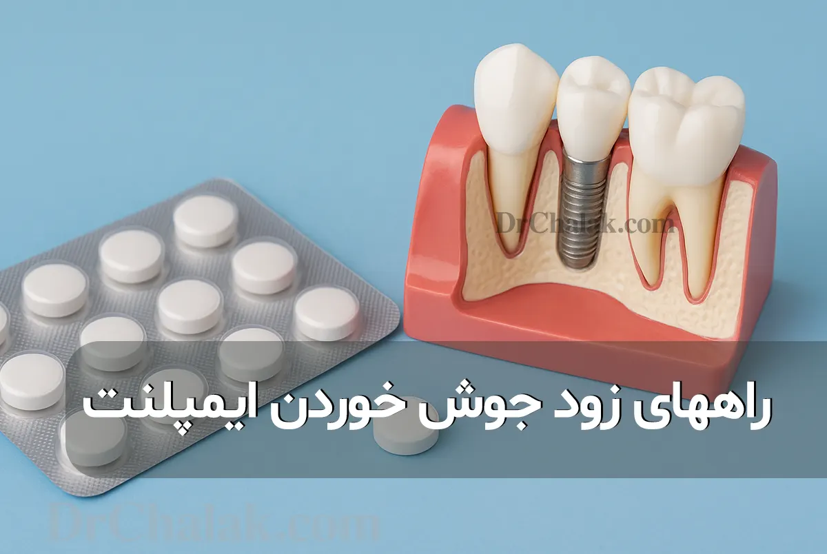 طرق لحام الزرعة بسرعة زيادة سرعة ترميم زراعة الأسنان 🦷✨