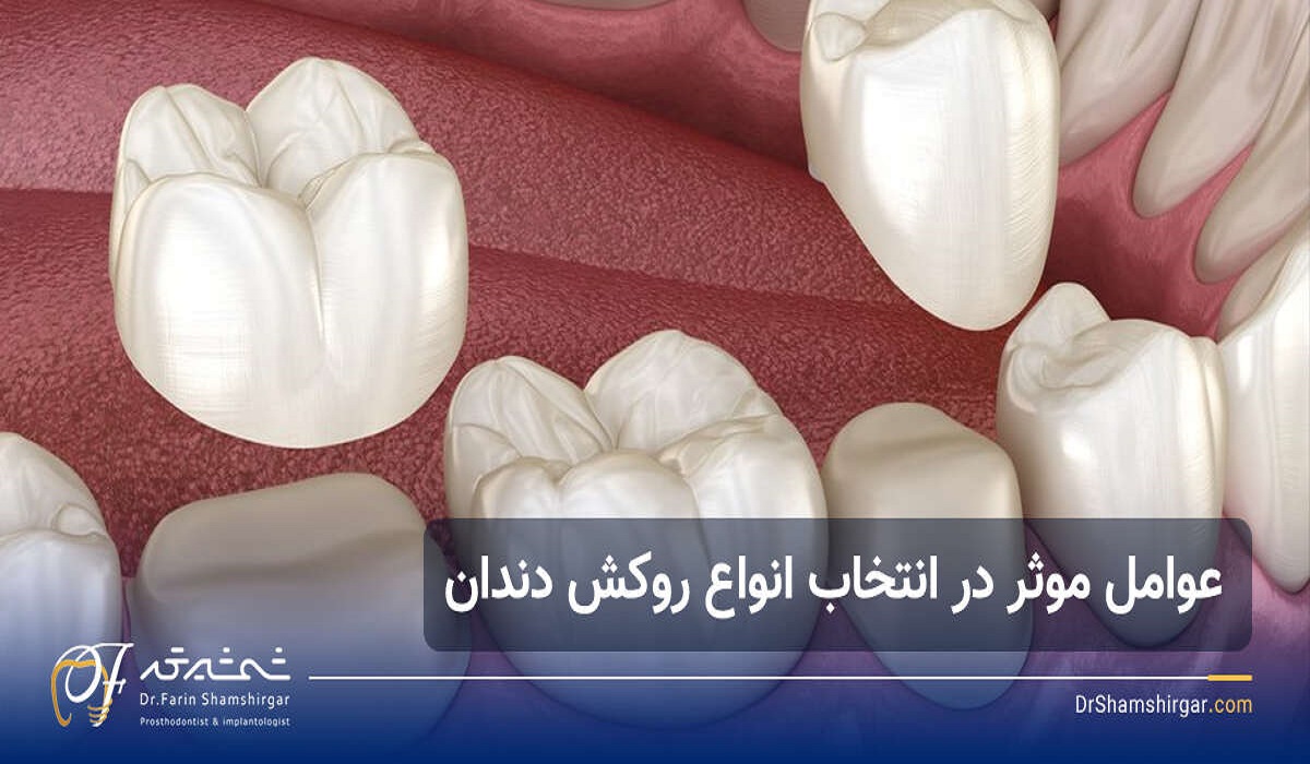 How to choose the best dental veneer?