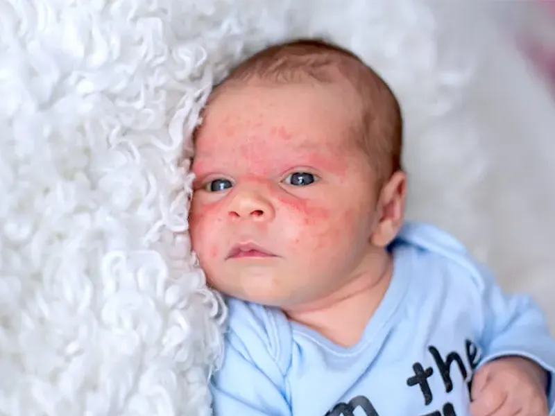 حساسية الطفل من حليب البقر - د. علي فرجي