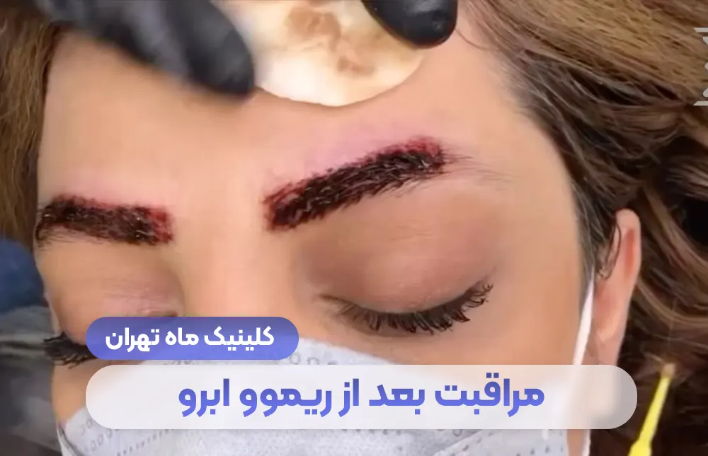 ماذا تفعل بعد إزالة الحاجب؟ العناية بعد إزالة الحواجب - عيادة ماه، طهران