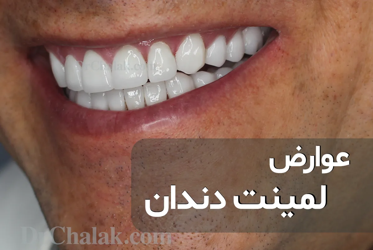 مضاعفات صفائح الأسنان وأسباب عدم الرضا عن الصفائح - دكتور شلك 🦷❤