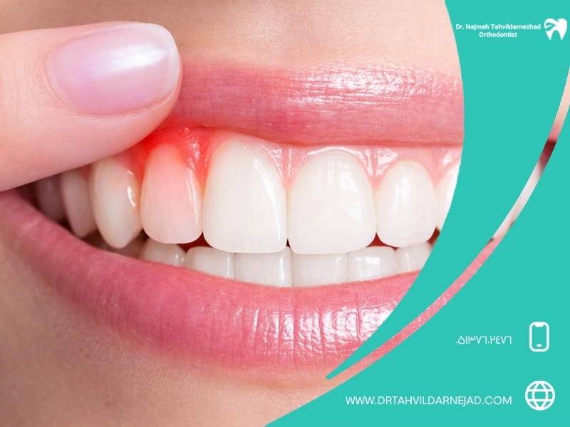 Investigating the impact of gum diseases on cardiovascular diseases Dr. Najmeh Tadredaranjad