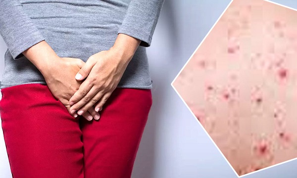 الثآليل التناسلية. طرق الانتقال والتشخيص والعلاج - د. عرفانه سليمي