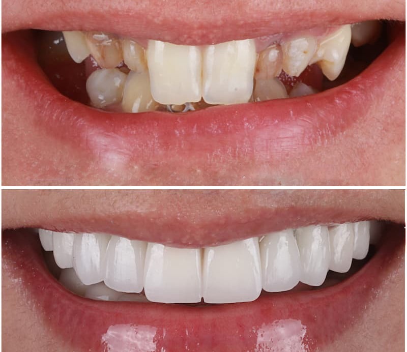 Rabbit tooth composite before and after + 100% correction cost Simin Barangi