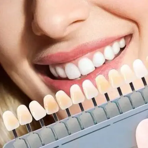 The price of dental laminate in 1403