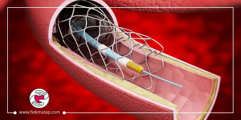 What is the probability of death in angiography? - Dr. Mustafa Hekmat