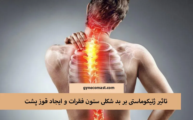 تاثیر ژنیکوماستی بر بدشکلی ستون فقرات و ایجاد قوز پشت