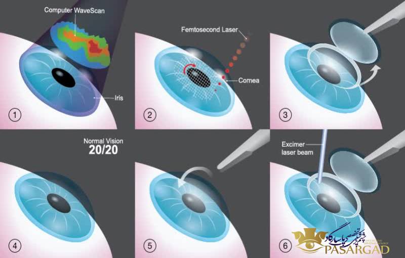كل شيء عن جراحة العيون بالليزك - دكتور حسين العمرداني