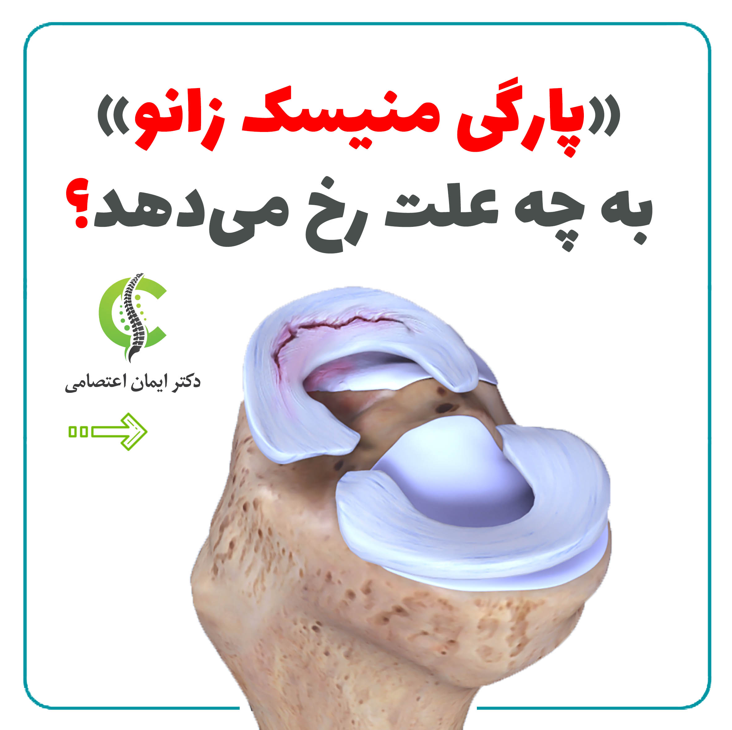 Knee meniscus tear and its causes