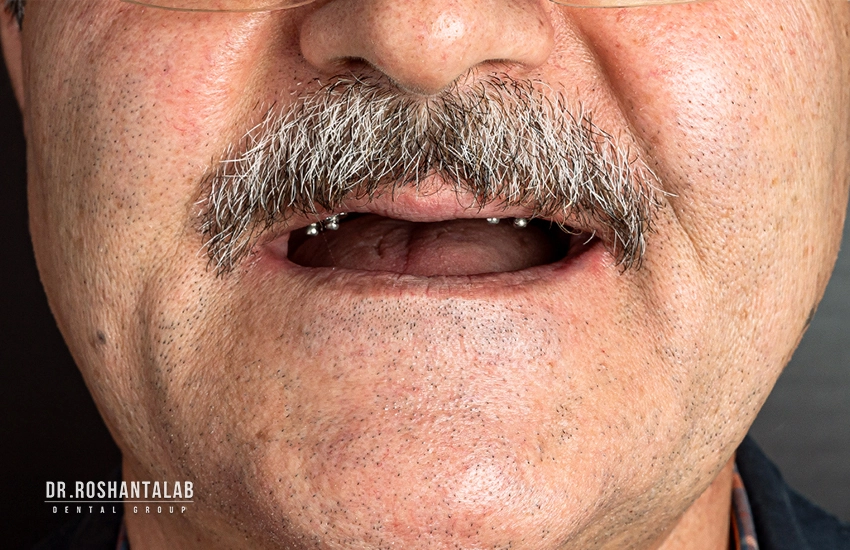 What is the most difficult stage of dental implant? Steps and duration