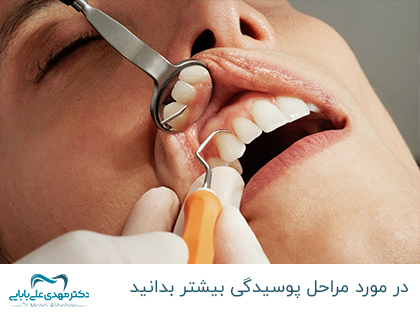 سبب تسوس الأسنان - الأعراض وطرق الوقاية والعلاج