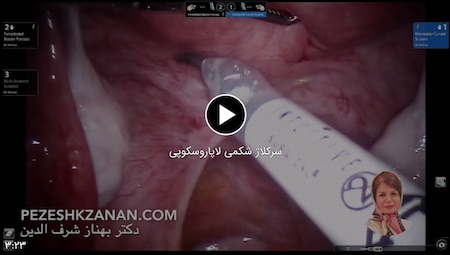 فيديو تطويق البطن بالمنظار - طبيبة النساء رشت د. بهناز شرف الدين - العقم، أطفال الأنابيب، تنظير البطن