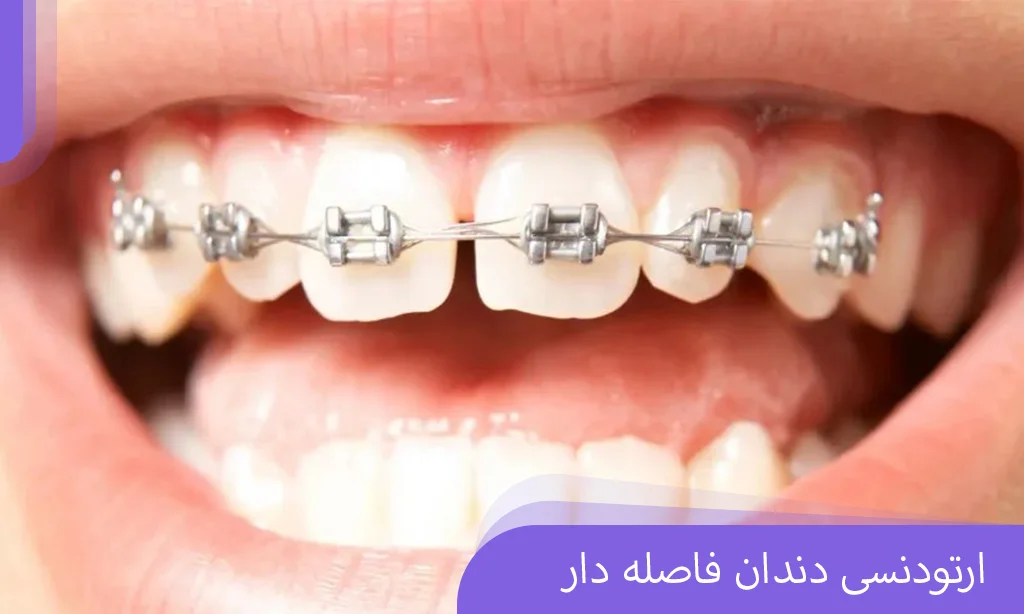 3 points of orthodontic interdental distance (steps, cost and duration) | Dr. Khadavi