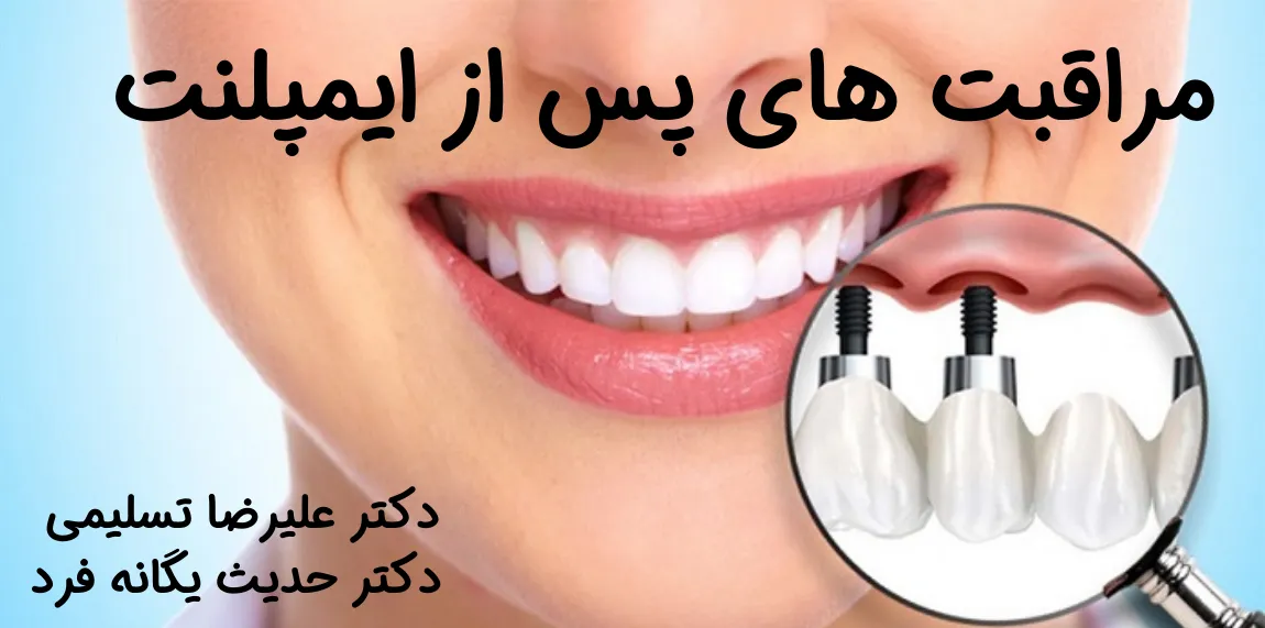 مراقبت های بعد از ایمپلنت دندان راهنمای کامل + نکات کلیدی