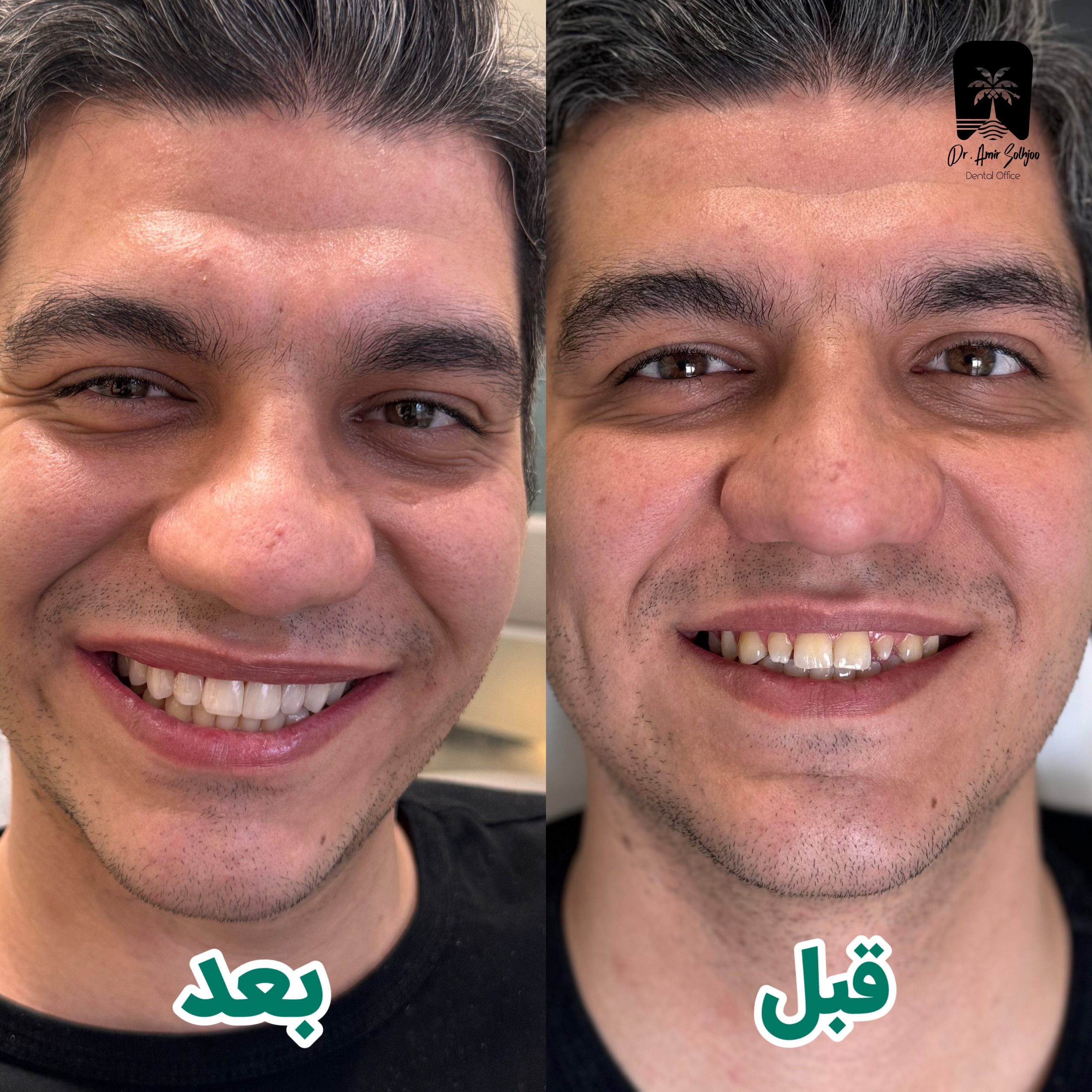 کامپوزیت طبیعی طبیعی ترین رنگ کامپوزیت + کاتالوگ و مشاوره رایگان