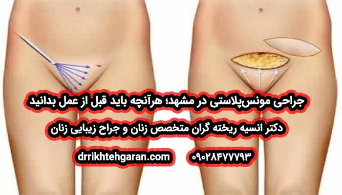 جراحی هایمنوپلاستی در مشهد; هر آنچه که باید قبل از جراحی بدانید