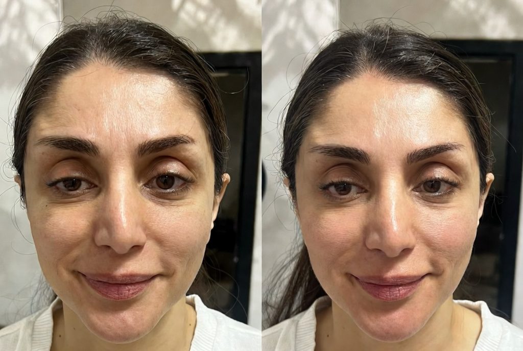 The best doctor for botox injection in Zafaranieh and Moghaddis, Ardabili: focusing on the forehead, frown line and eye area - Dr. Vida Shakiba Beauty Clinic | Zafaranieh and Sadeghieh, Tehran