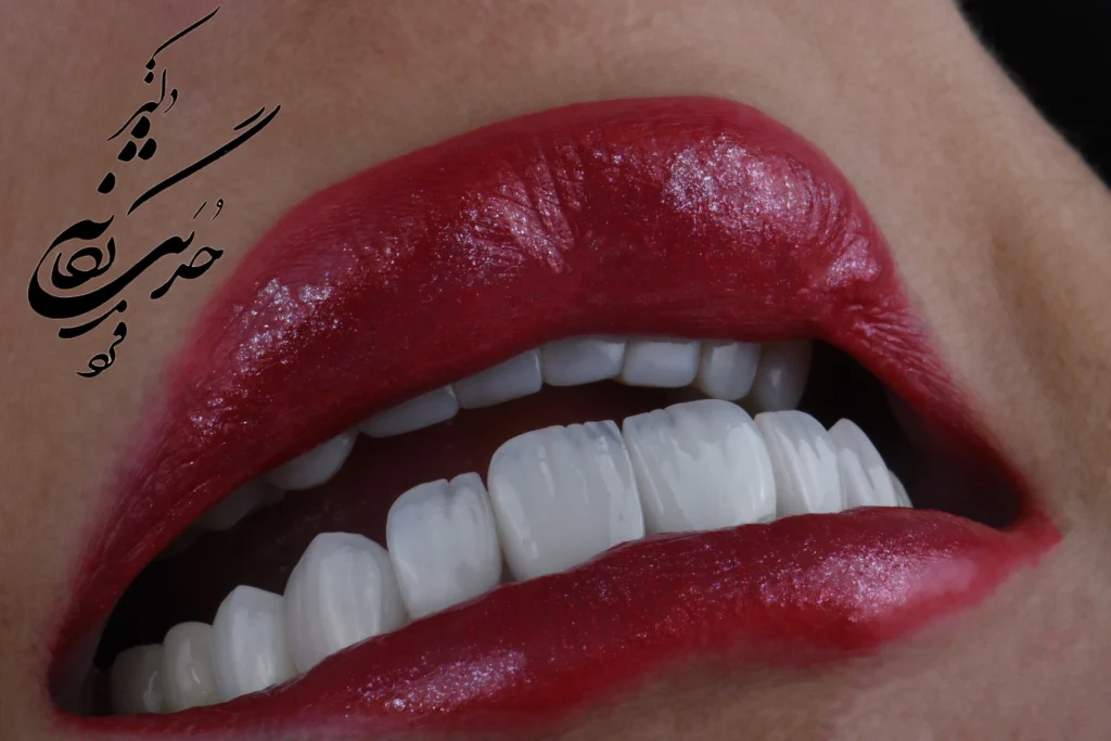 کامپوزیت دندان در تهران راهنمای کامل مزایا و معایب