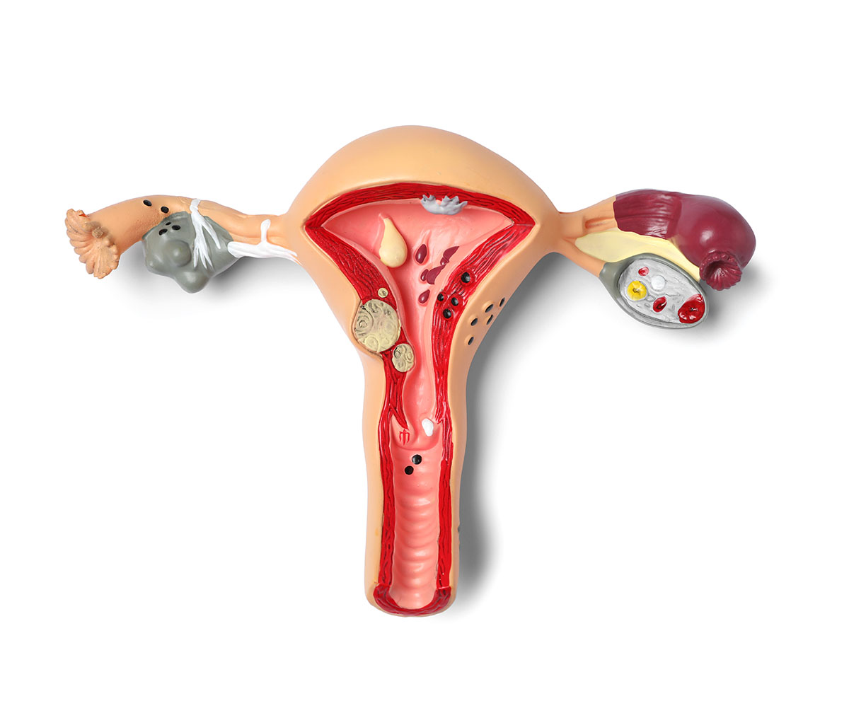 Uterine fibroids, zero to one hundred diagnosis, symptoms and treatment
