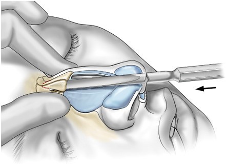 سوهان بینی بعد از جراحی چگونه انجام می شود؟
