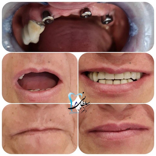 تعویض دندان فک بالا با ایمپلنت دکتر جمال سلطانی جراح دندانپزشک و متخصص ایمپلنت در تبریز