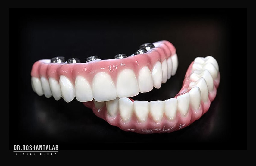 روکش های چسبی یا پیچی کاشت: کدام بهتر است؟