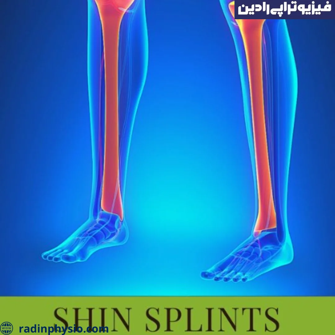 فیزیوتراپی شین اسپلینت چگونه انجام می شود؟ کلینیک فیزیوتراپی رادین