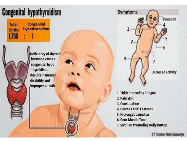 Symptoms of hypothyroidism in the first trimester of life - Dr. Masoumeh Hosni's personal website