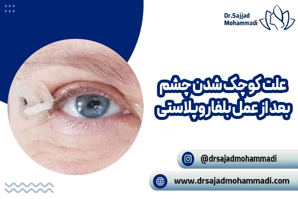 علت کوچک شدن چشم پس از بلفاروپلاستی؛ از علل تا پیشگیری