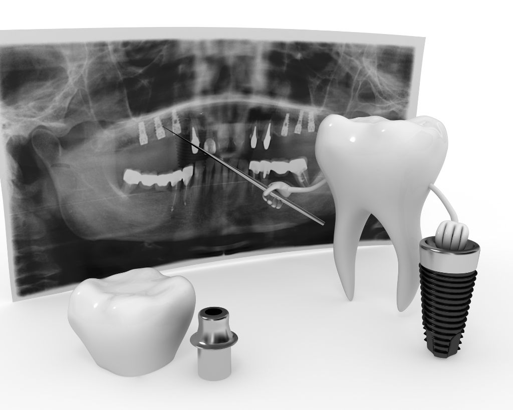 هل زراعة الأسنان تسبب السرطان؟ حقائق وإشاعات - طب أسنان الدكتور بهاري سيباهريان