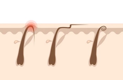 فیلم شستشوی کیست مو