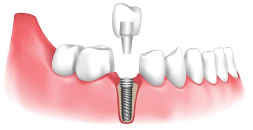 تفاوت بین ایمپلنت های یک مرحله ای و دو مرحله ای مراحل را مقایسه کنید