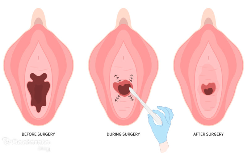 بعد از لابیاپلاستی چه مراقبت هایی لازم است؟