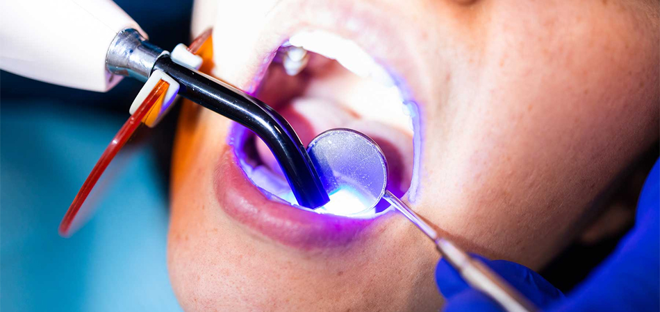 8 complications of dental composite that you must know!