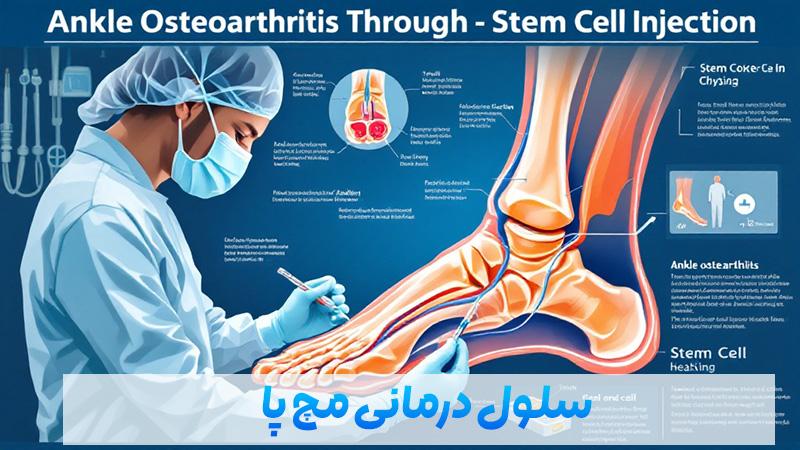 The best method of ankle arthritis treatment is ankle stem cell injection
