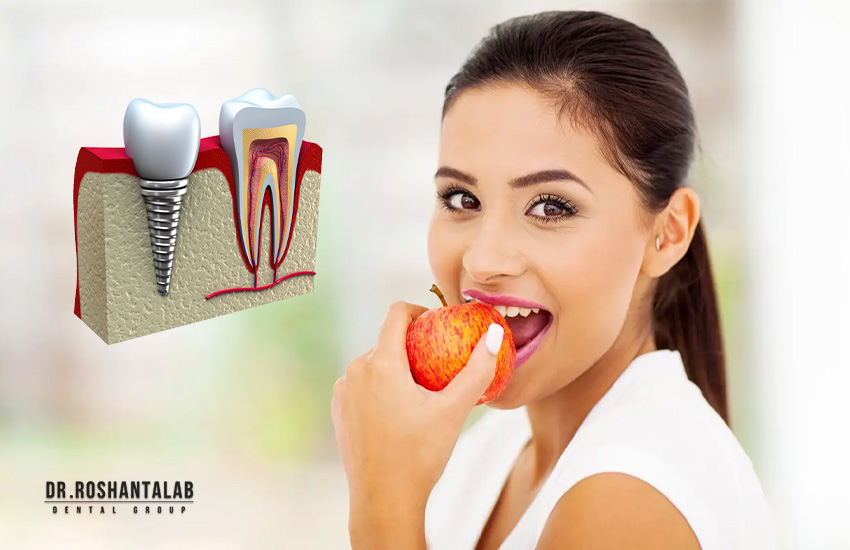 عمر ایمپلنت کره ای: انواع 7 تا از بهترین برندها و قیمت آن