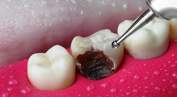 Restoration of the filled tooth + the cause of the wall and filling materials falling out