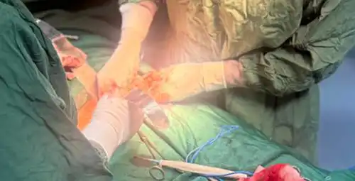 روش های جراحی در درمان اندومتریوز پیشرفته مروری علمی و به روز