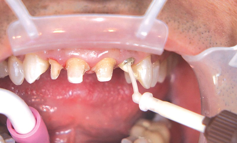 5 important differences between dental posts and implants which is better