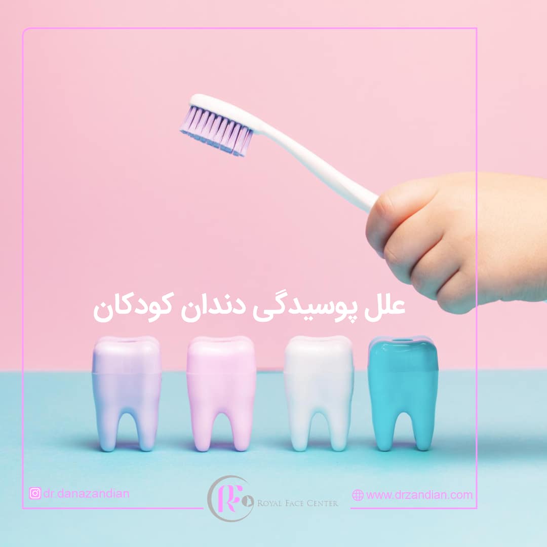 What is the cause of tooth decay? - Dr. Dana Zandian, specialist in orthodontics and dental anomalies