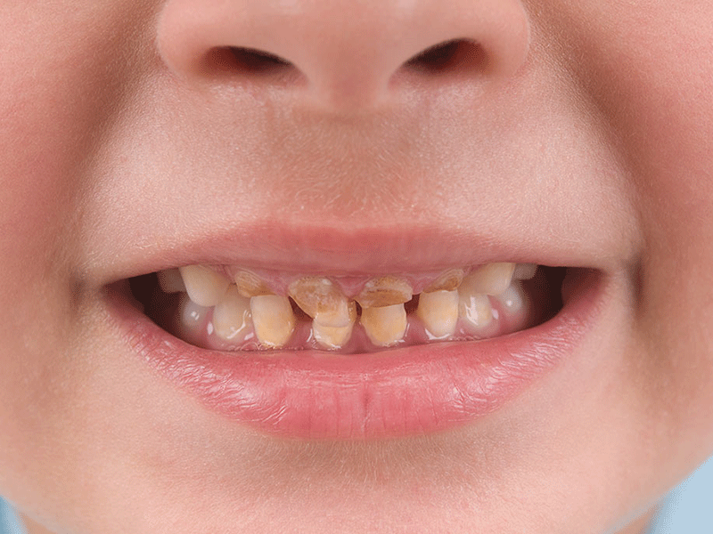 The best method for filling and repairing children's damaged teeth