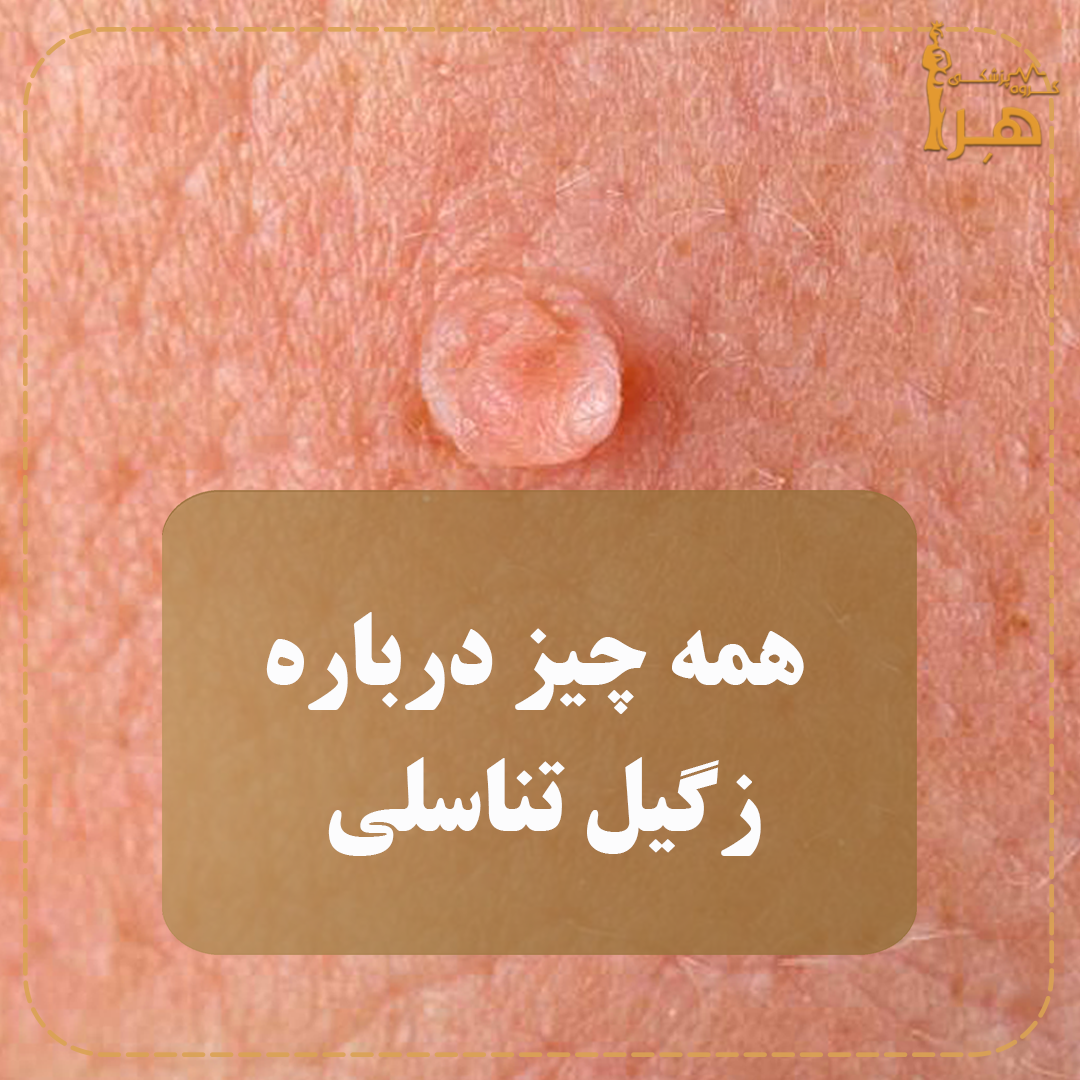 All about genital warts Treatment of genital warts in Tehran Treatment of genital warts in West Tehran