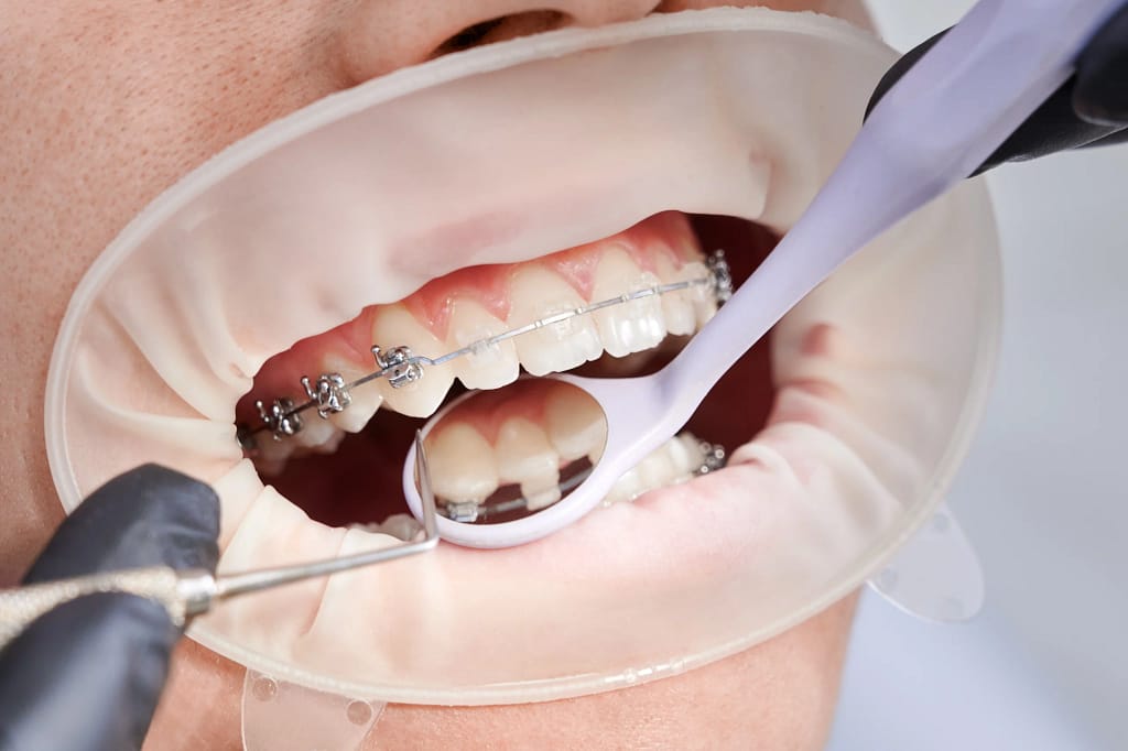 Ceramic orthodontics: everything about this popular treatment