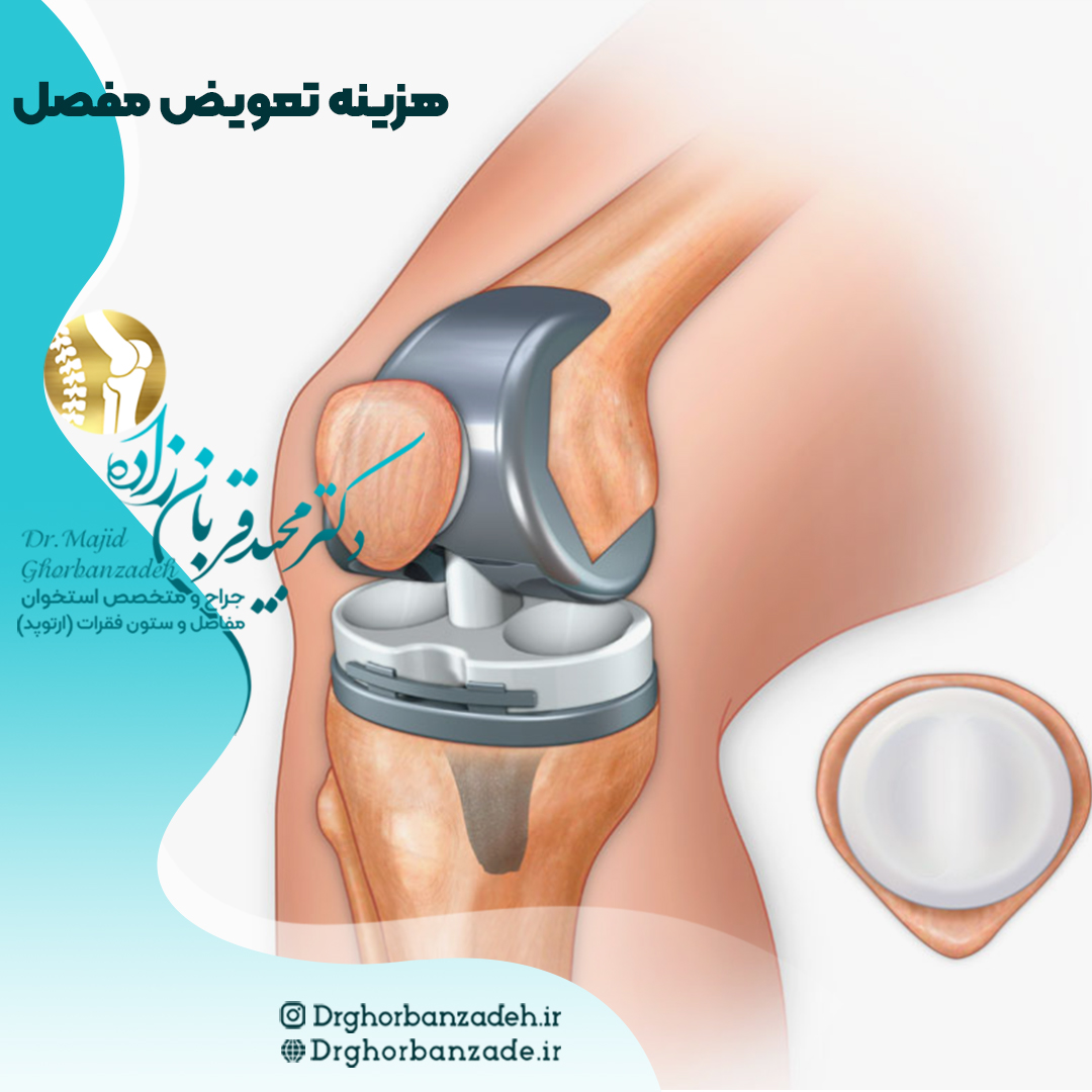 هزینه تعویض مفصل زانو - 5 نکته مهم دکتر مجید قربان زاده