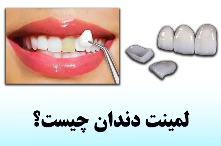 لمینت دندان چیست؟ (انواع لمینت مراحل نصب + عکس لمینت قبل و بعد)